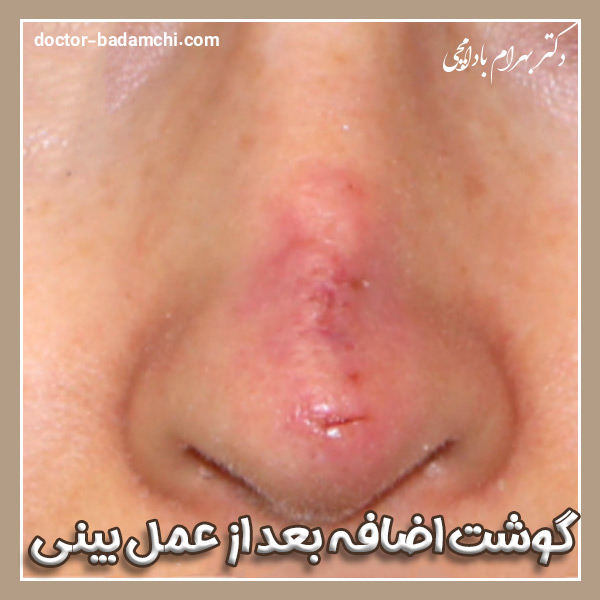 گوشت اضافه بعد از عمل بینی + دکتر بهرام بادامچی