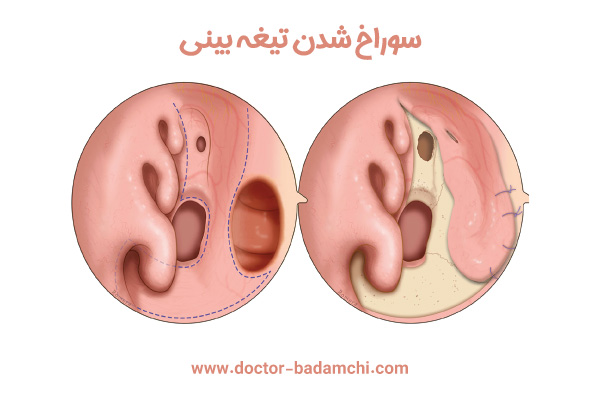 سوراخ شدن تیغه بینی + دکتر بهرام بادامچی