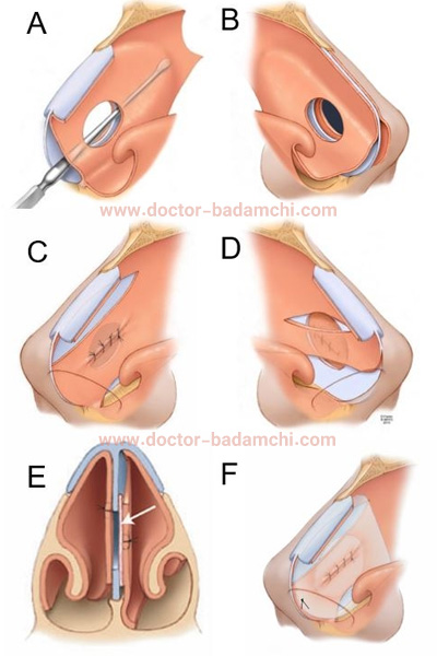 سوراخ شدن تیغه بینی + دکتر بهرام بادامچی