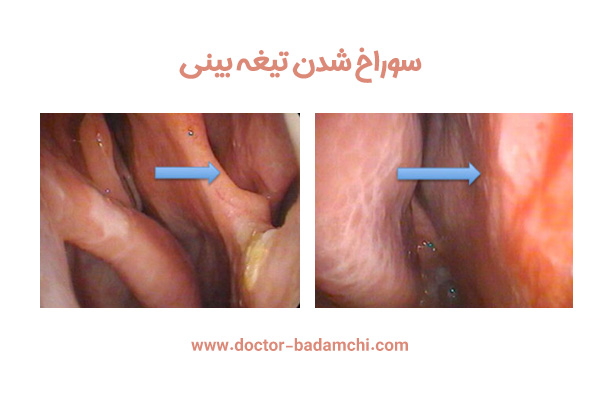 سوراخ شدن تیغه بینی + دکتر بهرام بادامچی
