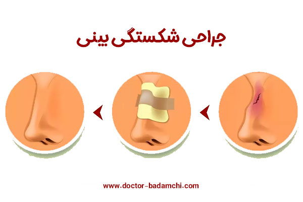 شکستگی بینی + دکتر بهرام بادامچی