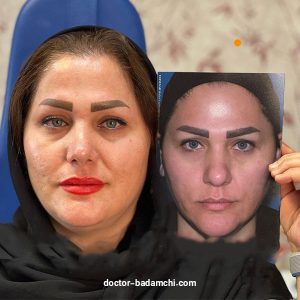 جراح بینی گوشتی در تهران - دکتر بهرام بادامچی