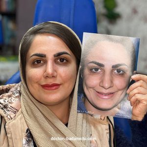 جراح بینی گوشتی در تهران - دکتر بهرام بادامچی