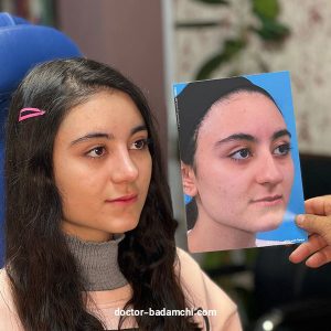 جراح بینی گوشتی در تهران - دکتر بهرام بادامچی