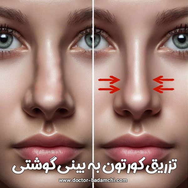 تزریق کورتون به بینی گوشتی - دکتر بهرام بادامچی