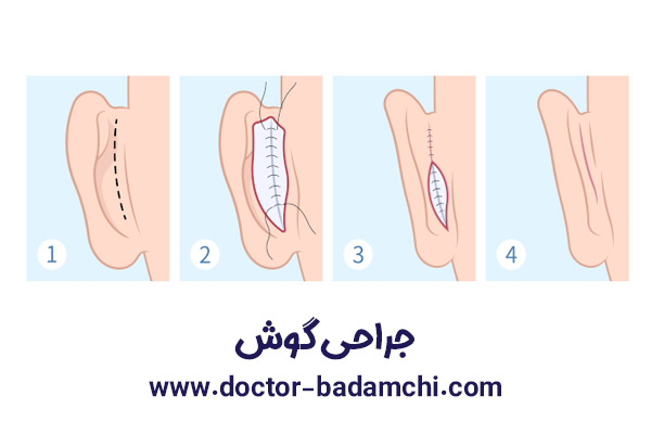 جراحی گوش در تهران | دکتر بهرام بادامچی