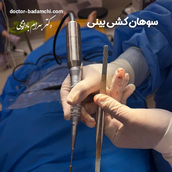 سوهان کشی بینی + دکتر بهرام بادامچی