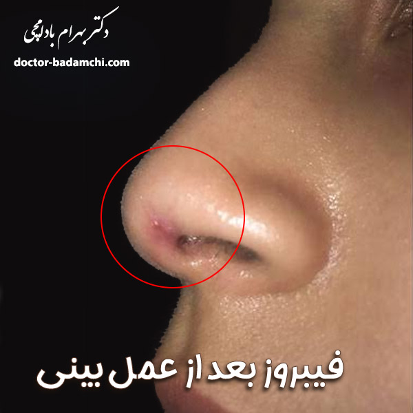 فیبروز بعد از عمل بینی + دکتر بهرام بادامچی