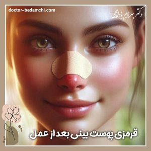 قرمزی پوست بینی بعد از عمل + دکتر بهرام بادامچی