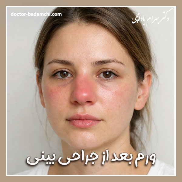 ورم بعد از جراحی بینی گوشتی + دکتر بهرام بادامچی