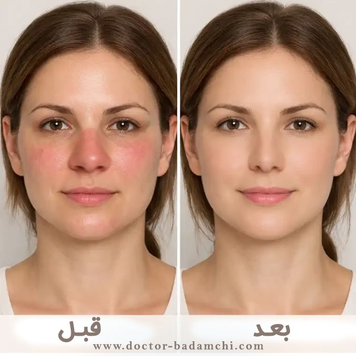 ورم بعد از جراحی بینی گوشتی + دکتر بهرام بادامچی