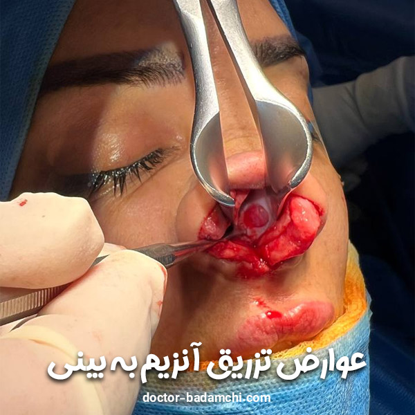 تزریق آنزیم به بینی + دکتر بهرام بادامچی