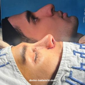 مراقبت های بعد از جراحی بینی + دکتر بهرام بادامچی