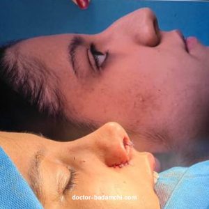 مراقبت های بعد از جراحی بینی + دکتر بهرام بادامچی