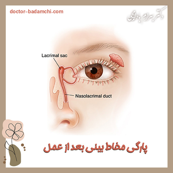 پارگی مخاط بینی بعد از عمل + دکتر بهرام بادامچی