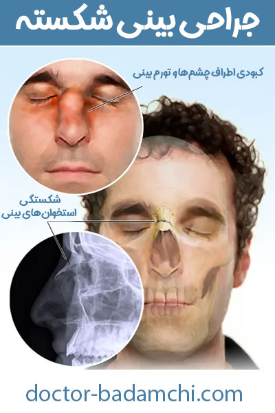 شکستگی بینی + دکتر بهرام بادامچی