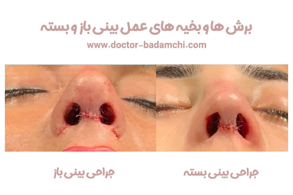 بخیه عمل بینی + دکتر بهرام بادامچی