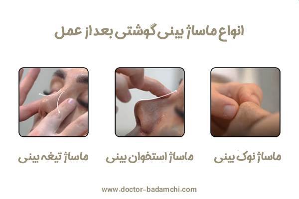 ماساژ بینی بعد از عمل بینی + دکتر بهرام بادامچی