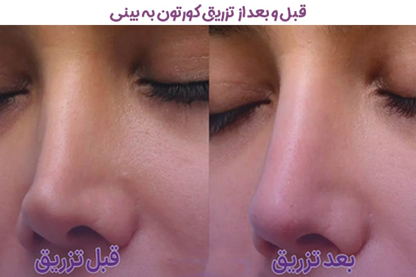 تزریق کورتون به بینی گوشتی + دکتر بهرام بادامچی