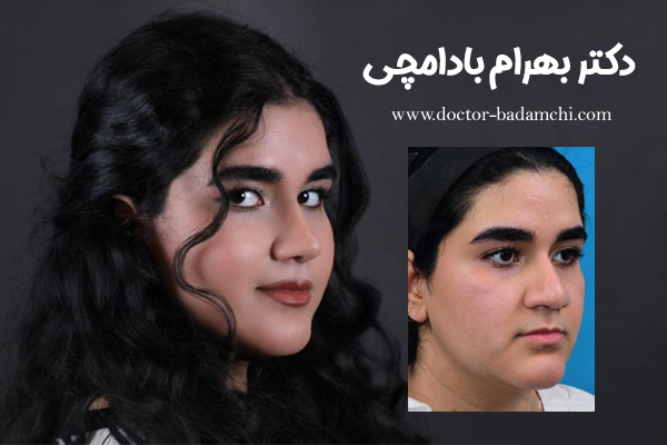 دکتر بهرام بادامچی بهترین جراح بینی گوشتی تهران