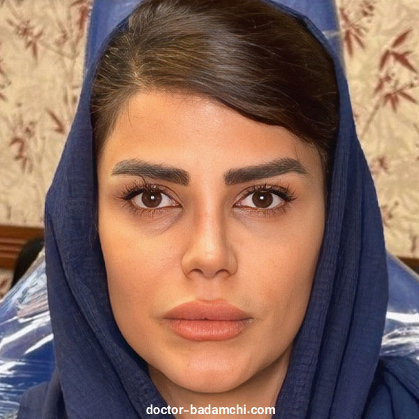 نمونه کارهای متخصص بینی گوشتی در تهران دکتر بهرام بادامچی