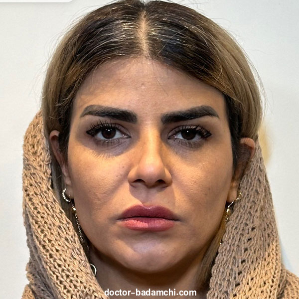 نمونه کارهای متخصص بینی گوشتی در تهران دکتر بهرام بادامچی
