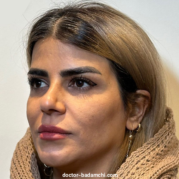 نمونه کارهای متخصص بینی گوشتی در تهران دکتر بهرام بادامچی