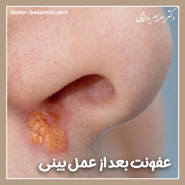 عفونت بعد از عمل بینی + دکتر بهرام بادامچی
