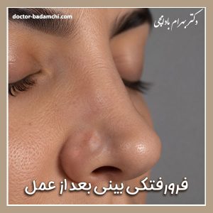 فرورفتگی بینی بعد از عمل + دکتر بهرام بادامچی
