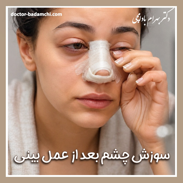 سوزش چشم بعد از عمل بینی + دکتر بهرام بادامچی