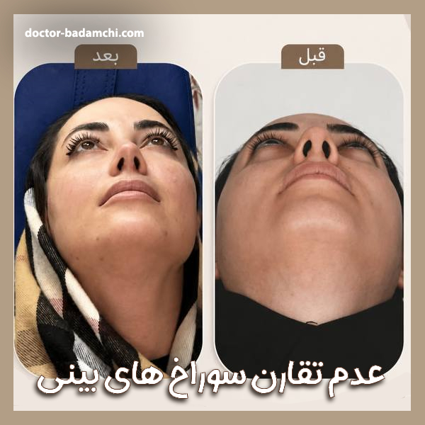 عدم تقارن سوراخ های بینی + دکتر بهرام بادامچی