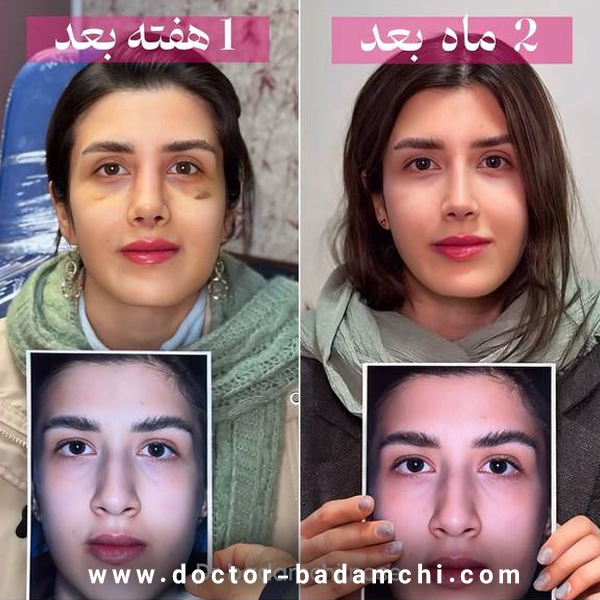 جراح بینی گوشتی در تهران | دکتر بهرام بادامچی