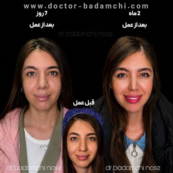 نمونه کار دکتر بادامچی جراح بینی گوشتی تهران