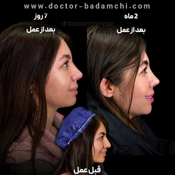 نمونه کار دکتر بادامچی جراح بینی گوشتی تهران