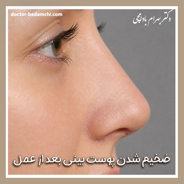 ضخیم شدن پوست بینی بعد از عمل + دکتر بهرام بادامچی