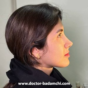 جراحی بینی استخوانی در تهران | دکتر بهرام بادامچی